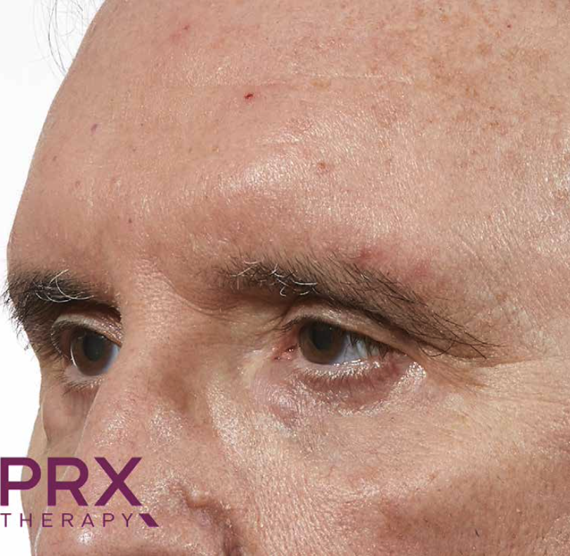 Pelle del viso dopo il trattamento PRX-T33, caso 9