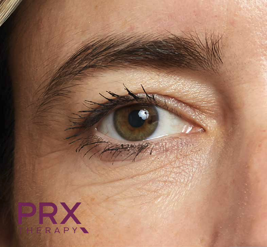 Pelle del viso prima del trattamento PRX-T33, caso 5