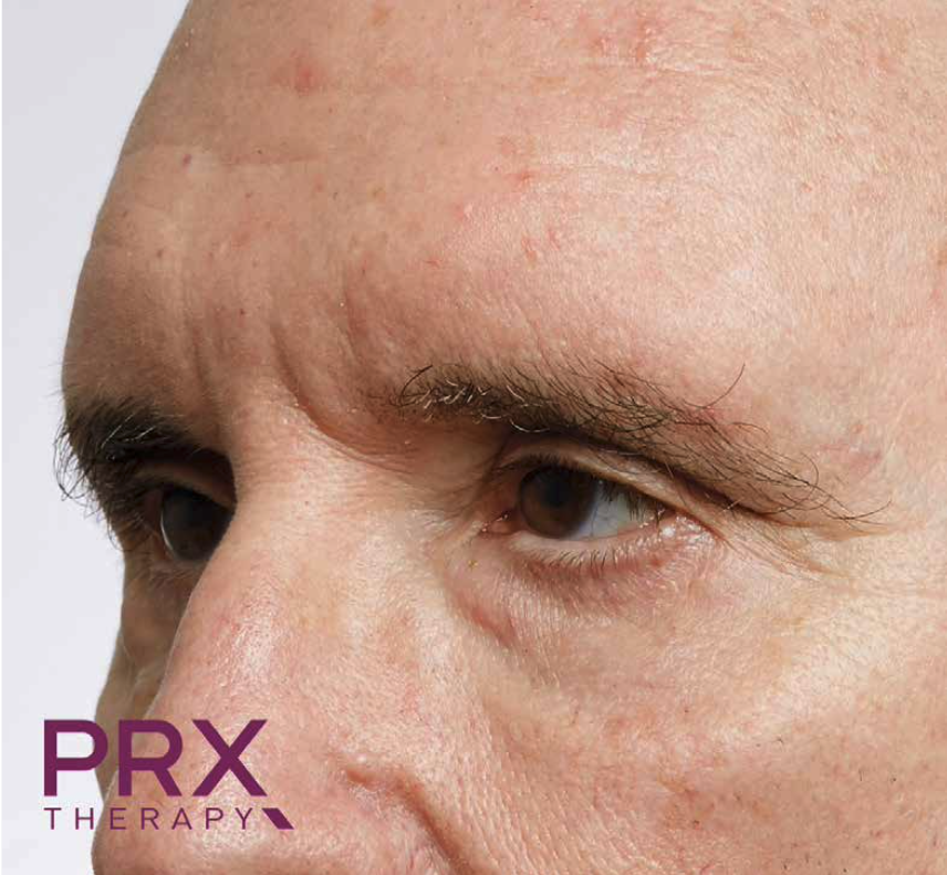 Pelle del viso prima del trattamento PRX-T33, caso 9